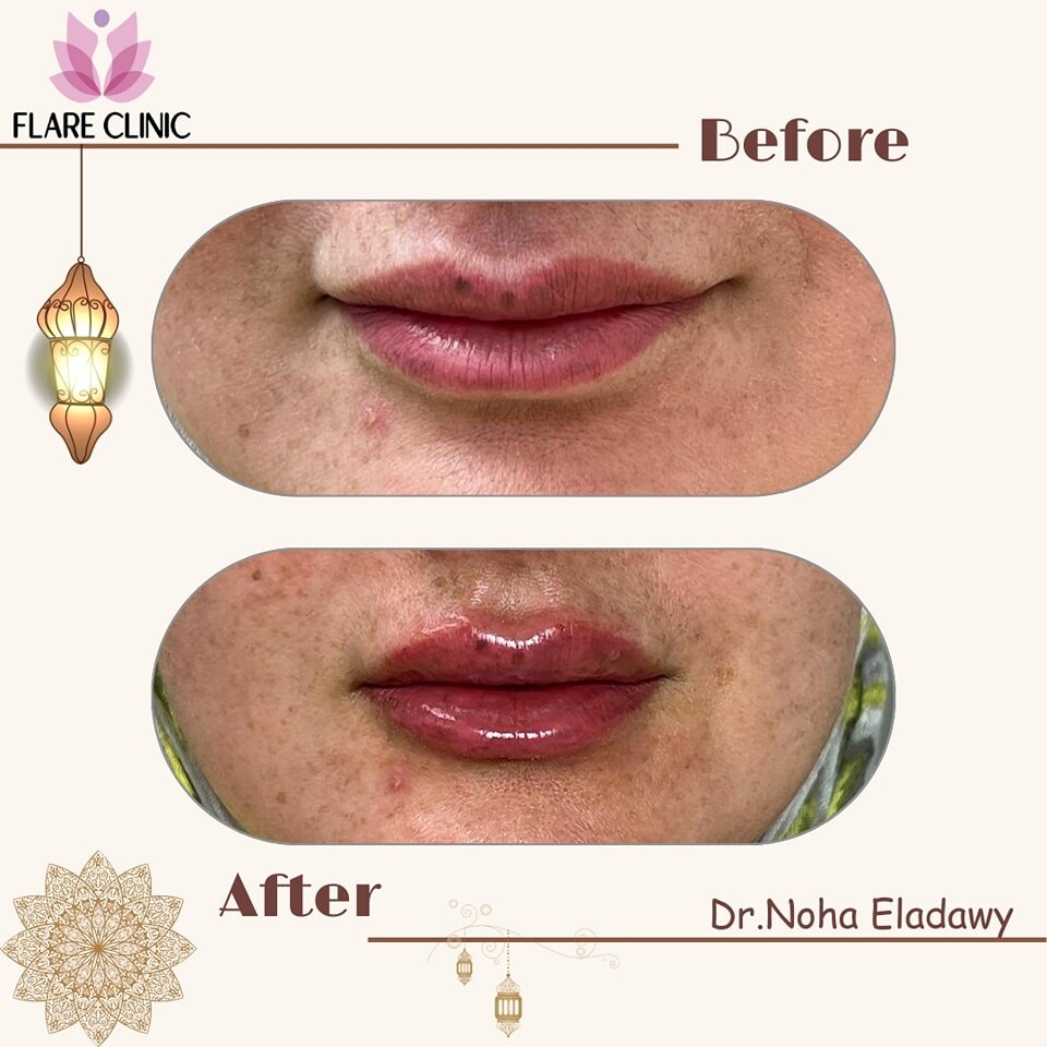 Before and After Result